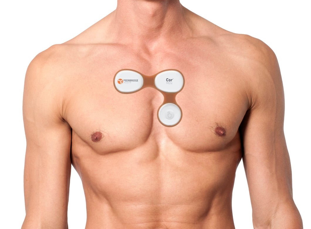 From Tethered to Truly Wireless Cardiac Monitoring